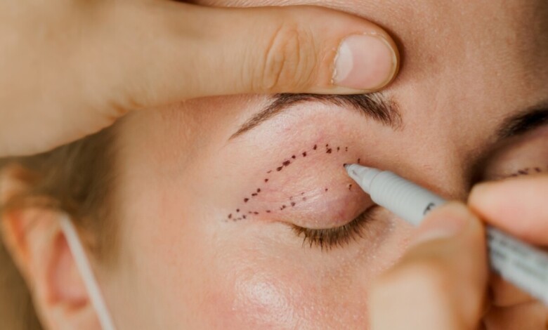 بهترین دکتر بلفاروپلاستی در اصفهان