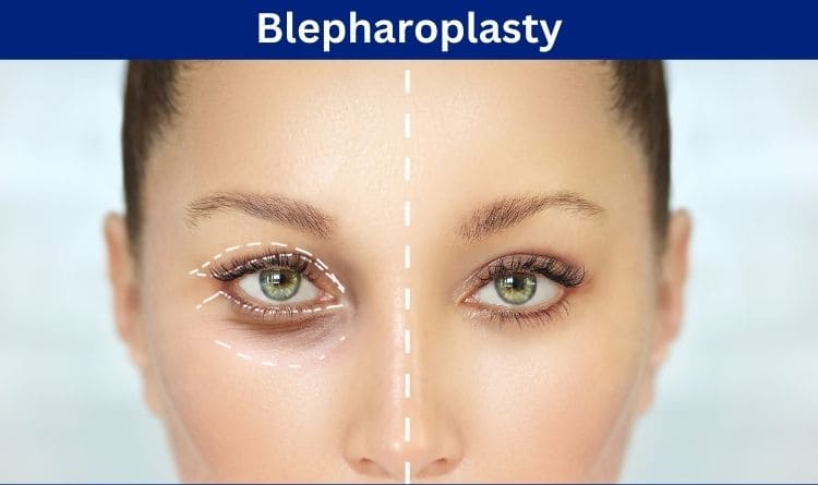بهترین جراح بلفاروپلاستی در اصفهان