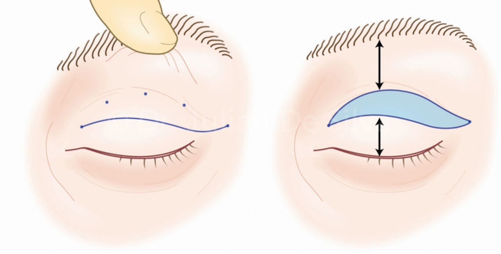 بهترین مرکز بلفاروپلاستی در اصفهان