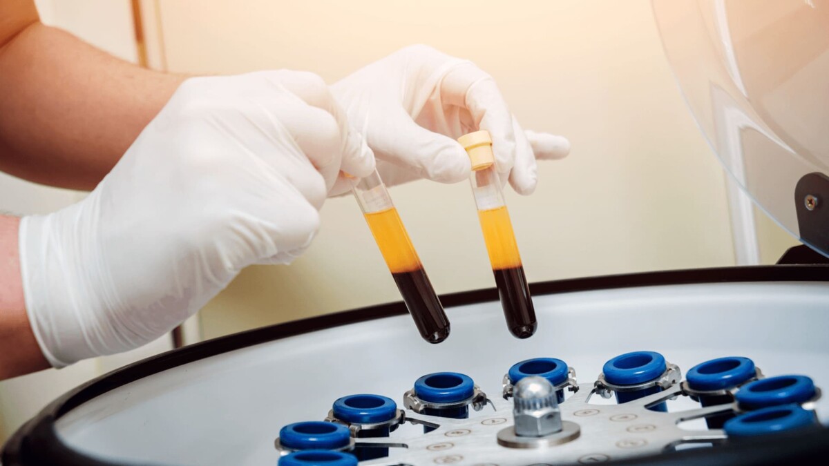 پی آر پی چیست و چگونه انجام می‌شود؟