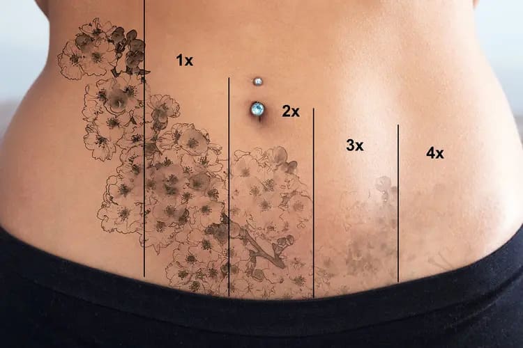پاک کردن تاتو در اصفهان