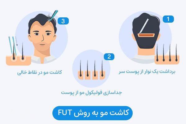 کاشت مو به روش FUT در اصفهان