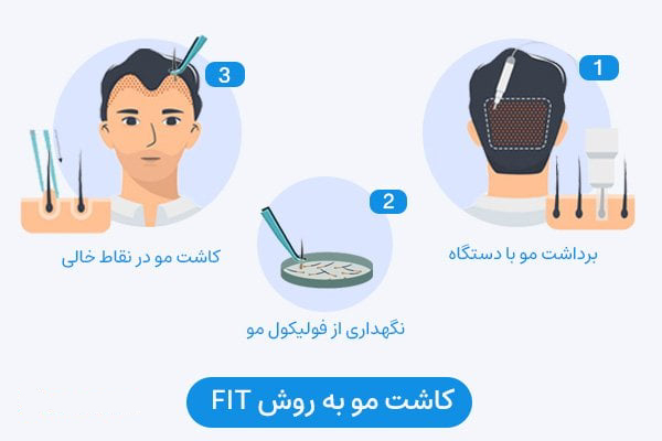 کاشت مو به روش FIT در اصفهان