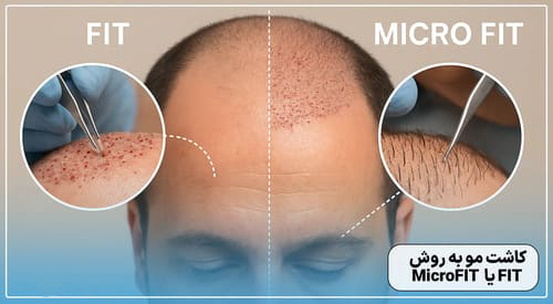 کاشت مو به روش Micro FIT (میکروفیت) در اصفهان