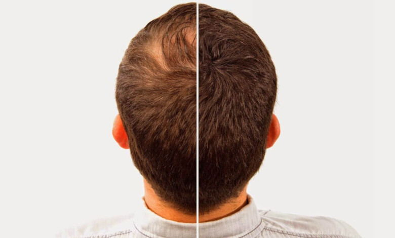 بهترین مرکز کاشت مو در اصفهان