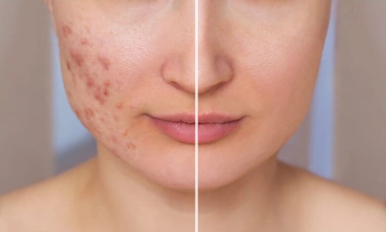 بهترین دکتر برای درمان اسکار اصفهان