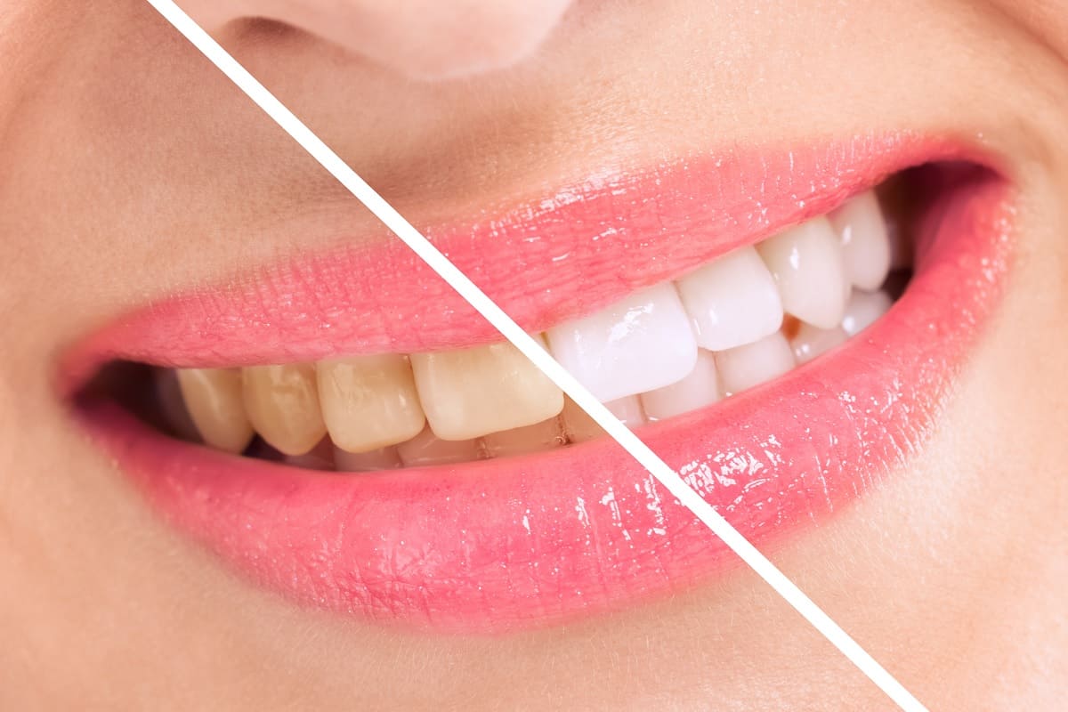 قیمت بلیچینگ دندان در اصفهان و عوامل موثر روی آن