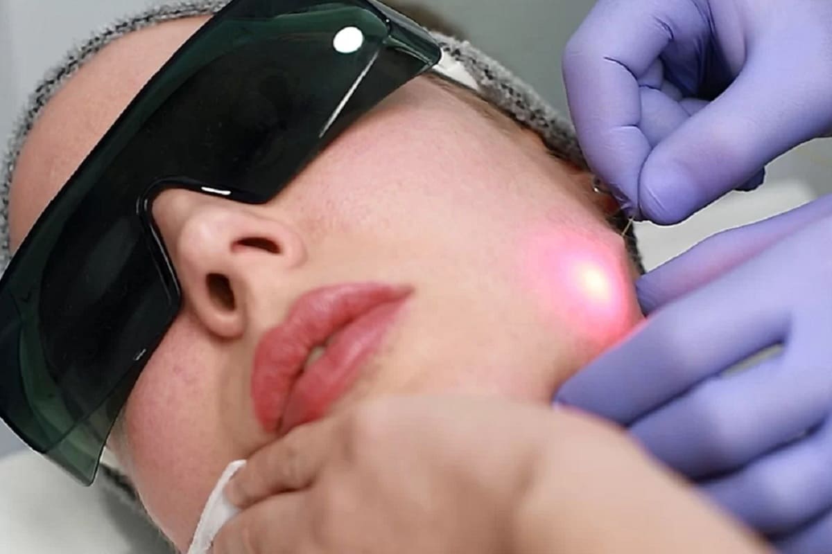 مزایا و معایب اندولیفت صورت در اصفهان