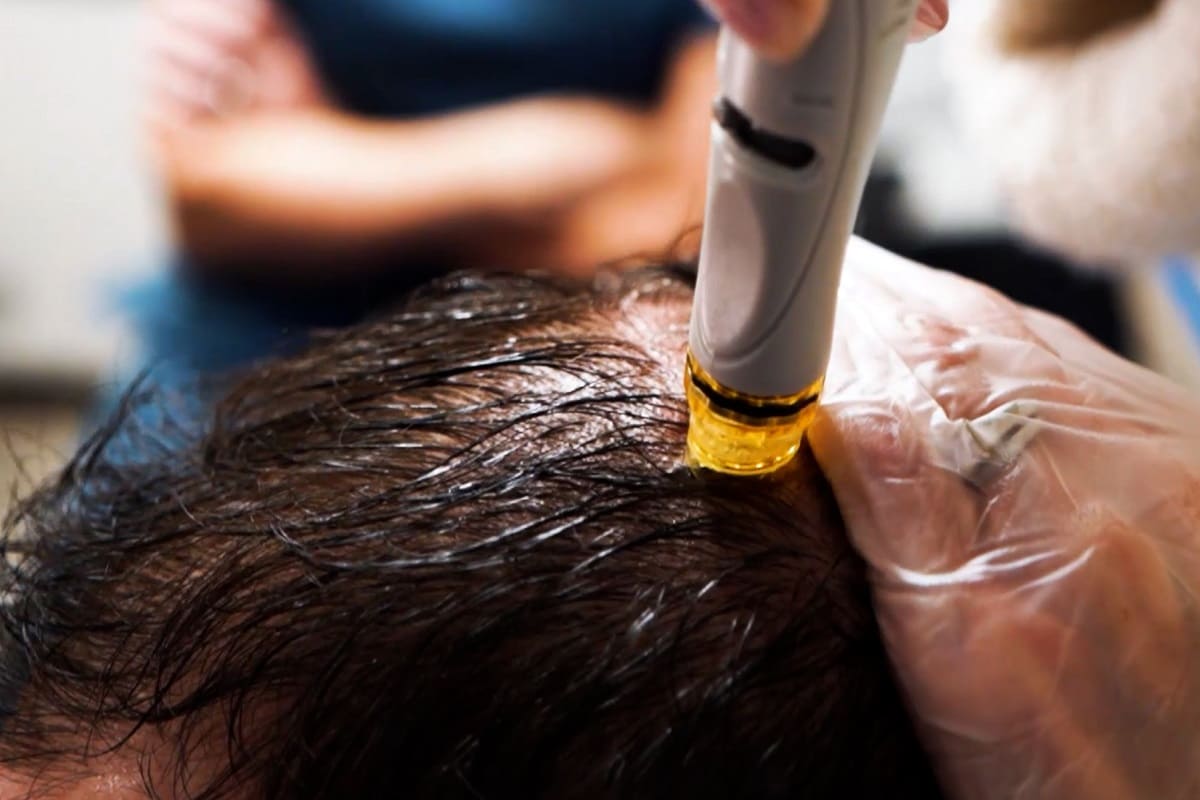 هزینه اسکالپ اصفهان و عوامل موثر