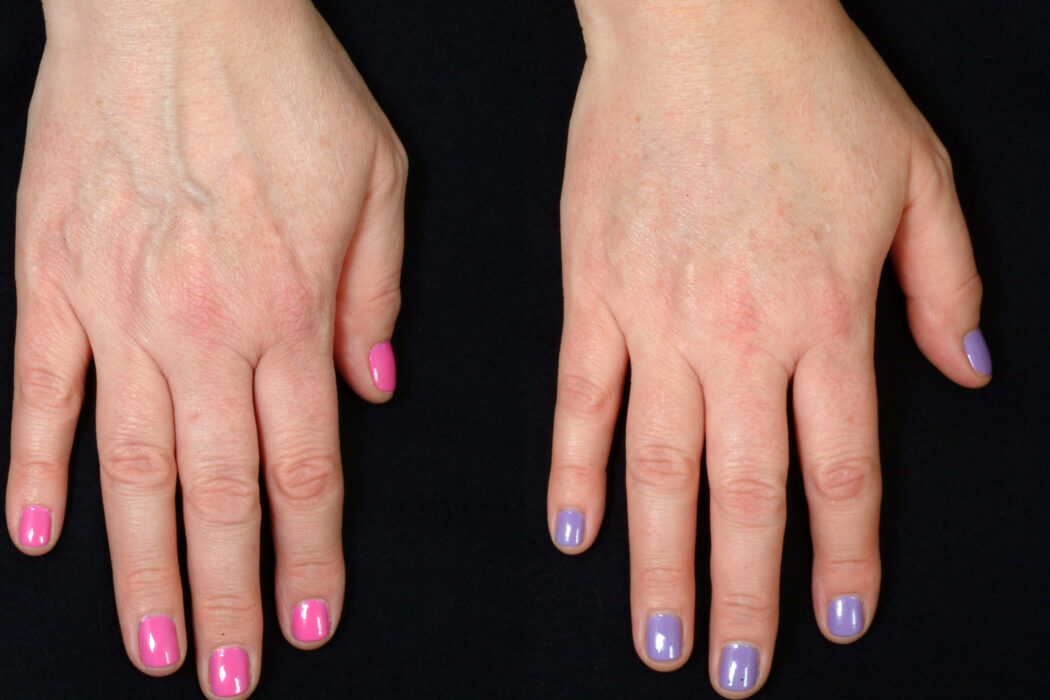 دکتر فیلر بادی در اصفهان