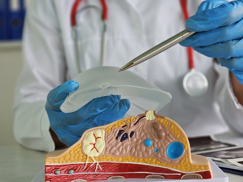 بهترین جراح لیفت سینه در اصفهان