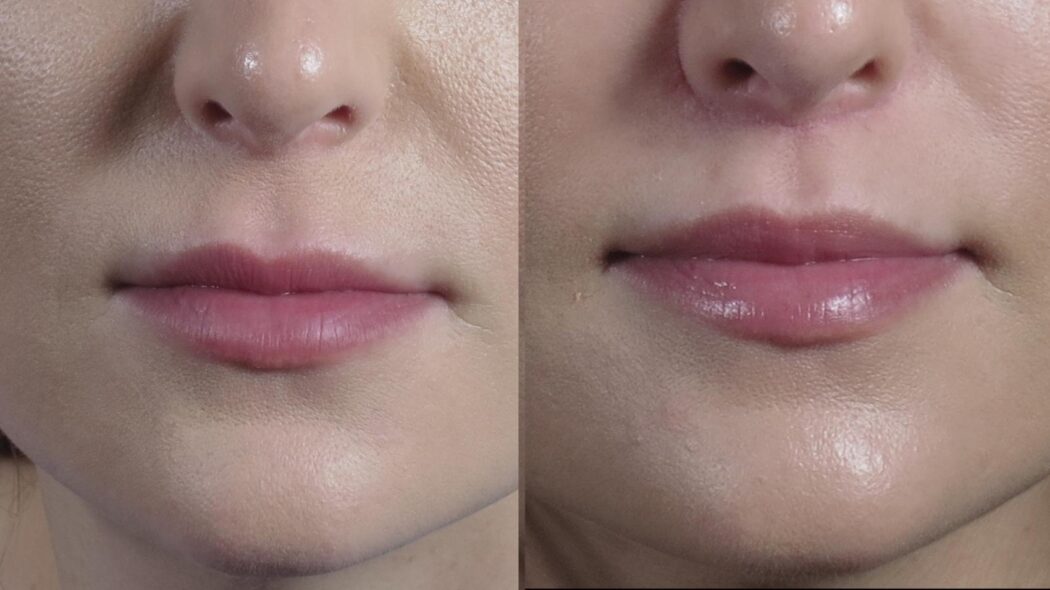 بهترین جراح سانترال لب در اصفهان