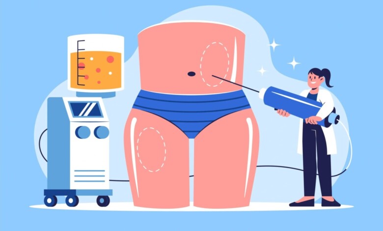 بهترین دکتر لیپوساکشن در اصفهان