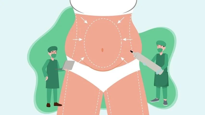 بهترین جراح لیپوساکشن اصفهان