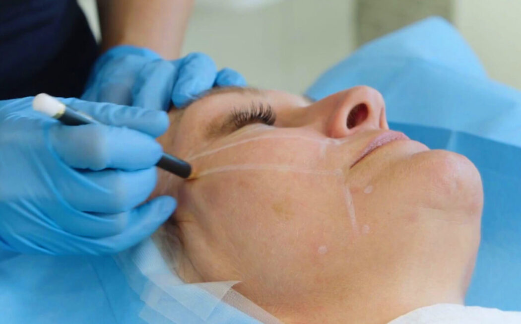 لیفت با نخ در اصفهان