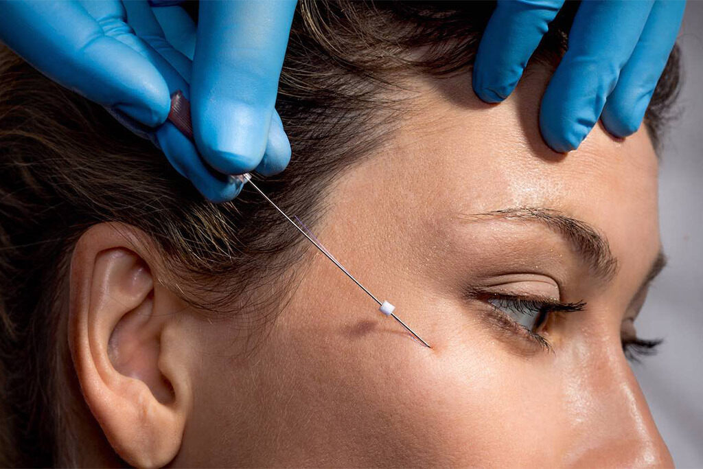 بهترین دکتر لیفت صورت با نخ در اصفهان