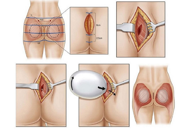 پروتز باسن در اصفهان