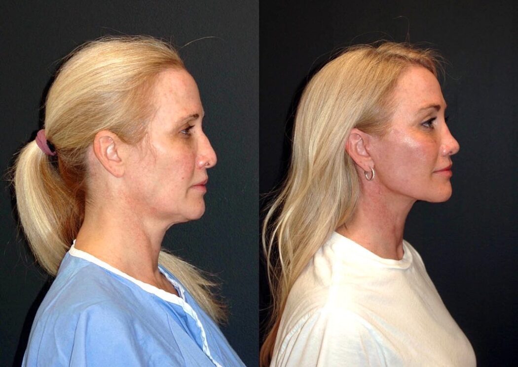 مینی لیفت صورت اصفهان