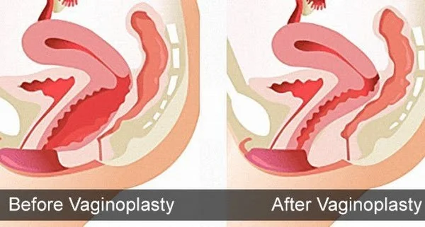 دکتر خوب برای تنگی واژن اصفهان