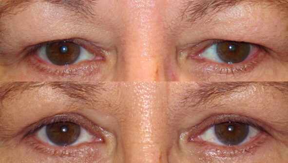 بلفاروپلاستی در شیراز