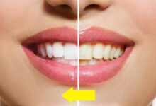 بهترین دکتر لمینت دندان در شیراز